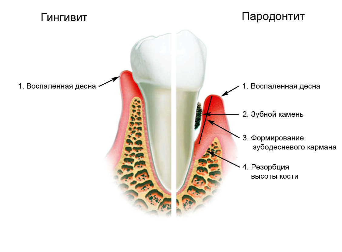 пародонтит